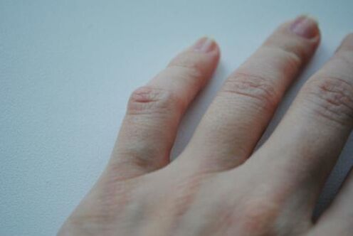 Joint swelling appeared on the little finger. 
