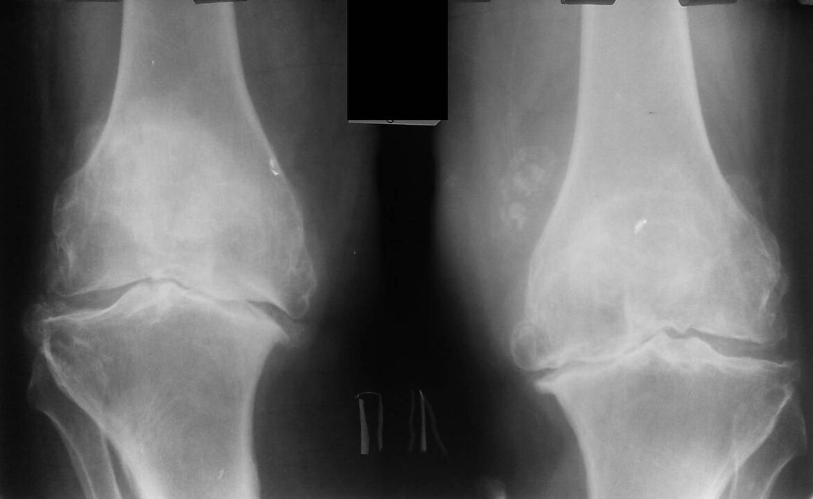 radiography of the knee joints with arthrosis