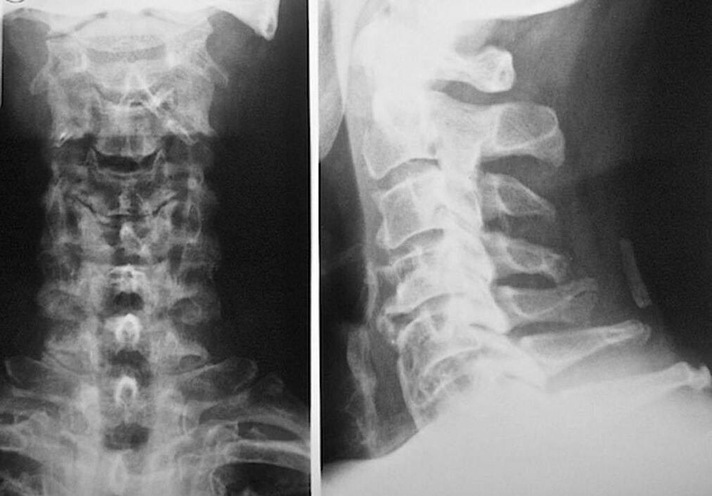radiograph of the cervical spine with osteochondrosis