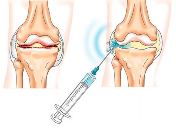intraarticular injections for knee arthrosis