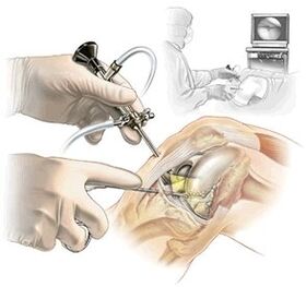 To clarify the diagnosis of dash -drug arthrosis