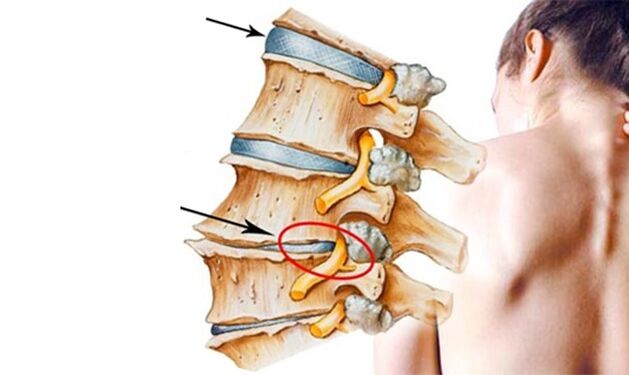 pinched nerve in the spine as a cause of low back pain