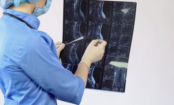 The diagnosis of cervical osteochondrosis is based on an MRI examination